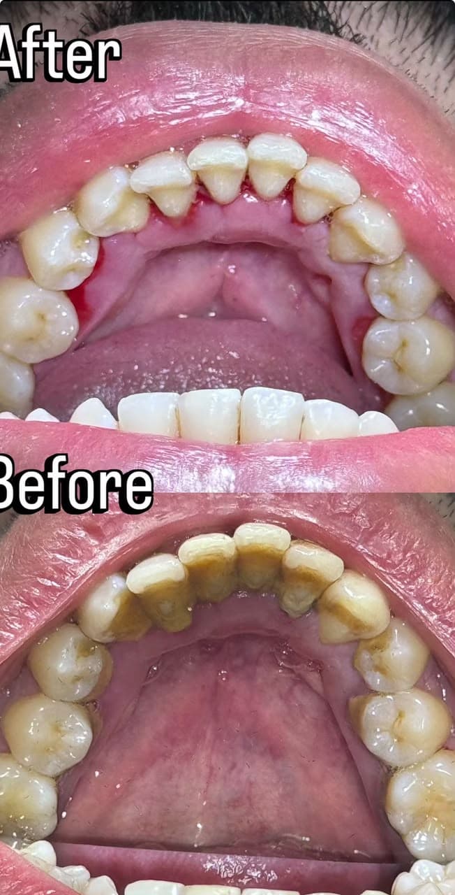 Professional Cleaning & Smile Improvement - Before and After