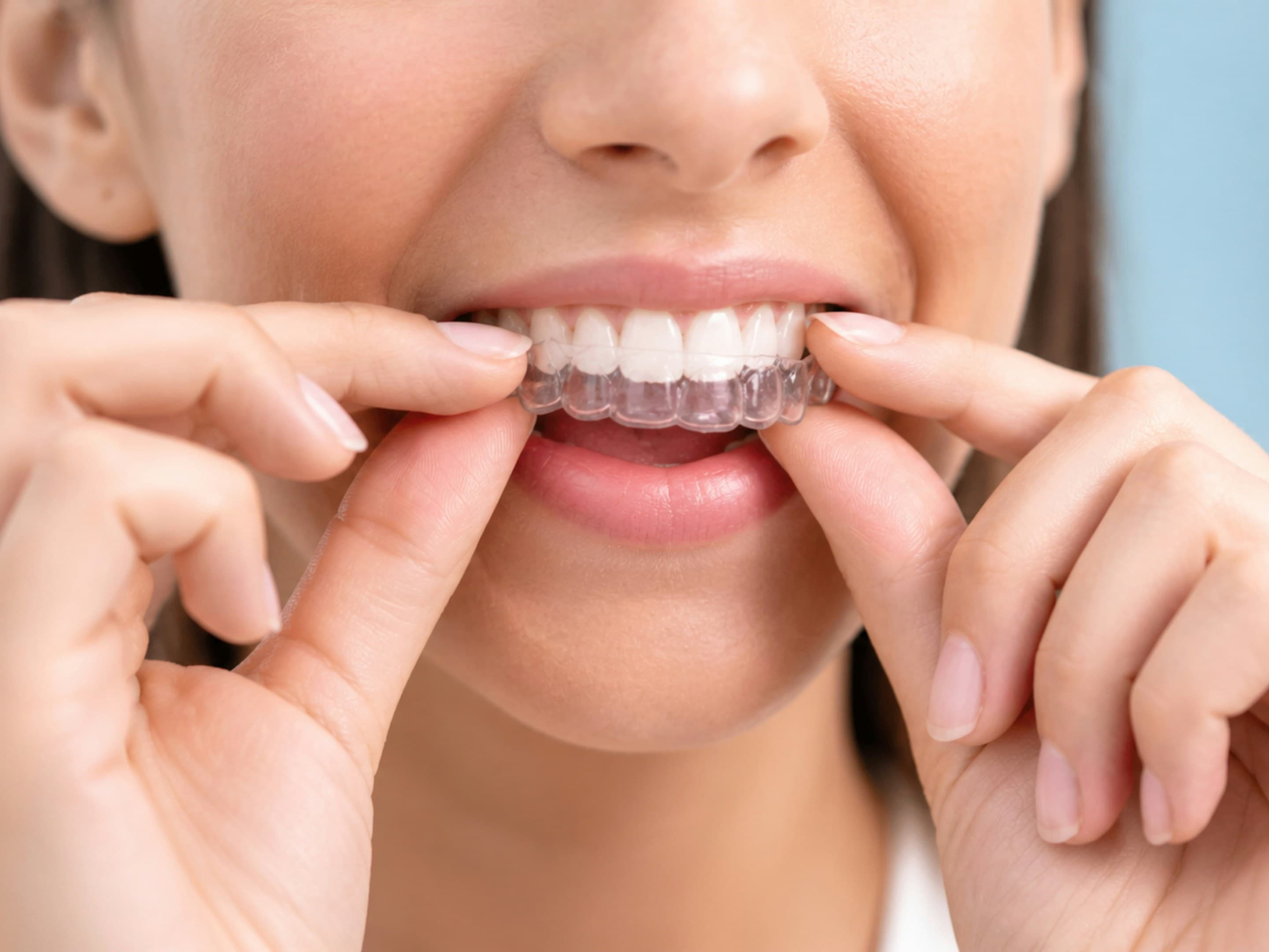 Clear aligners treatment at Hafeez Dental Care