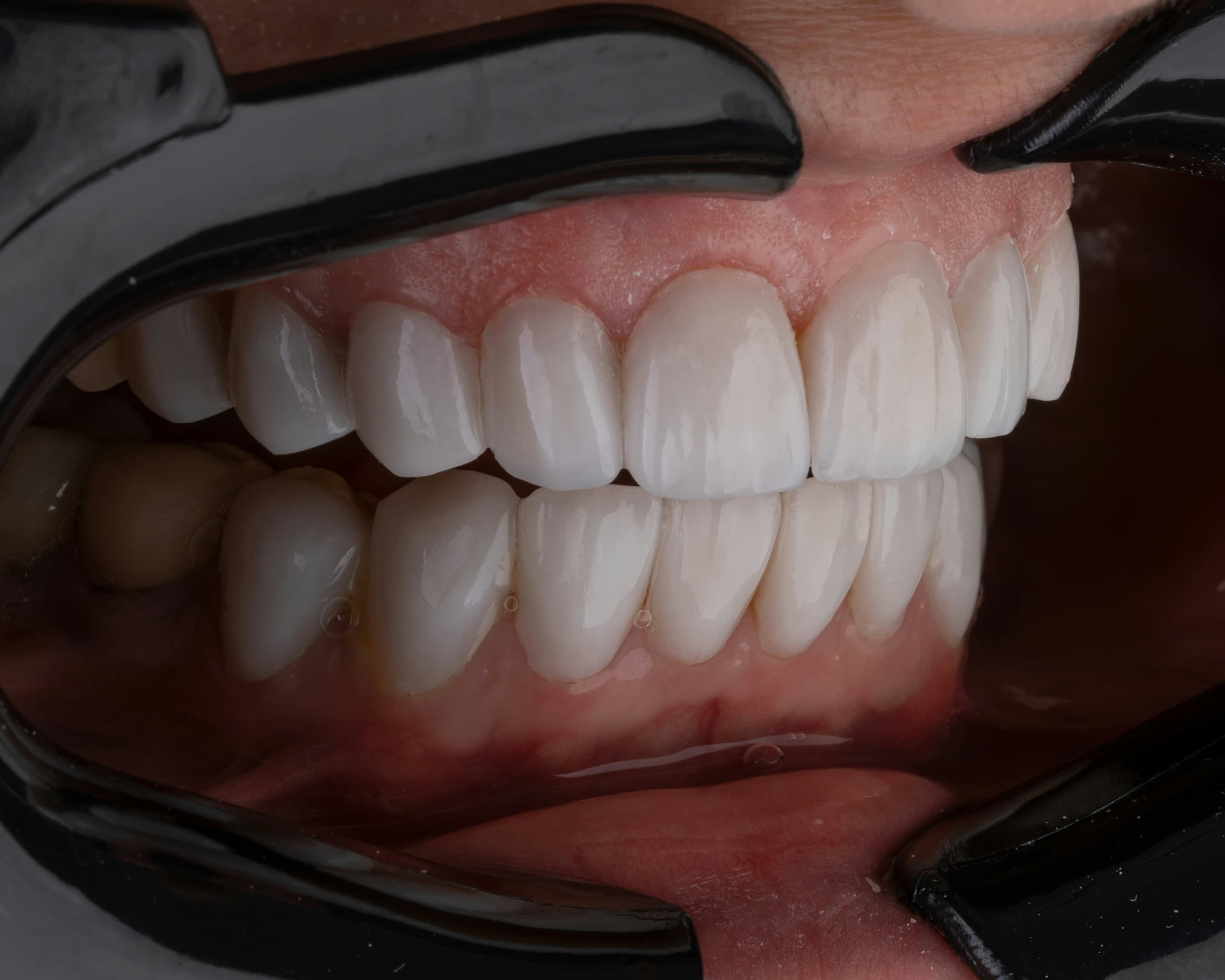 Dental implants treatment at Hafeez Dental Care