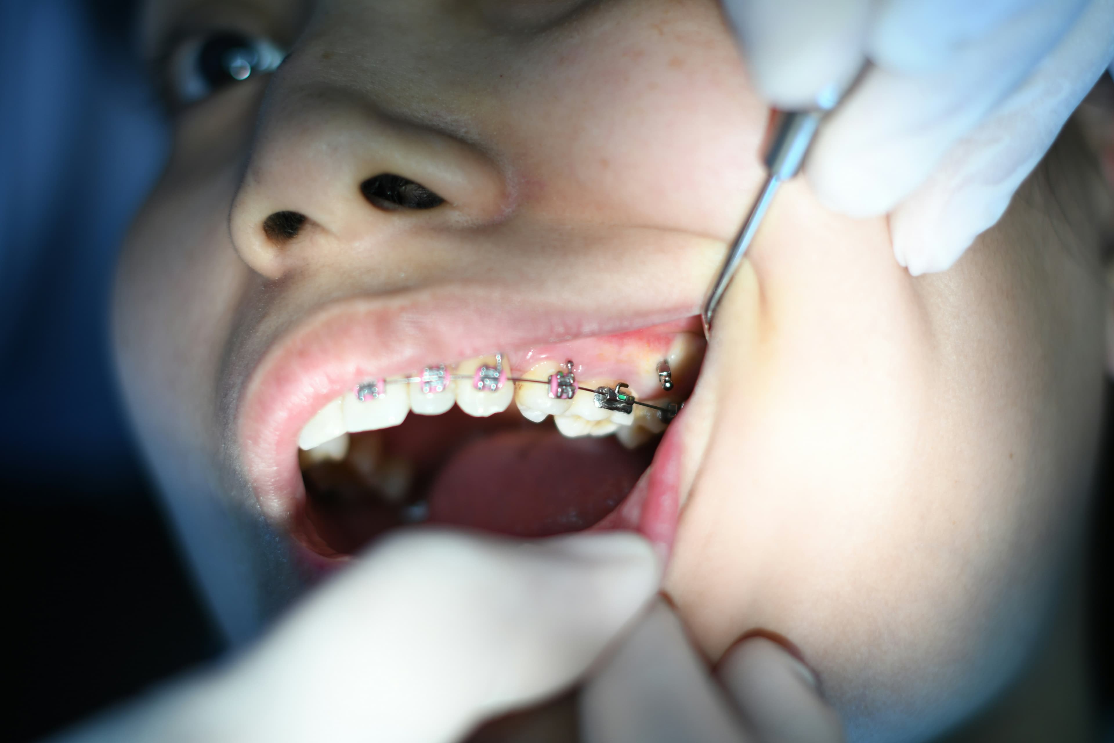 Orthodontic treatment at Hafeez Dental Care