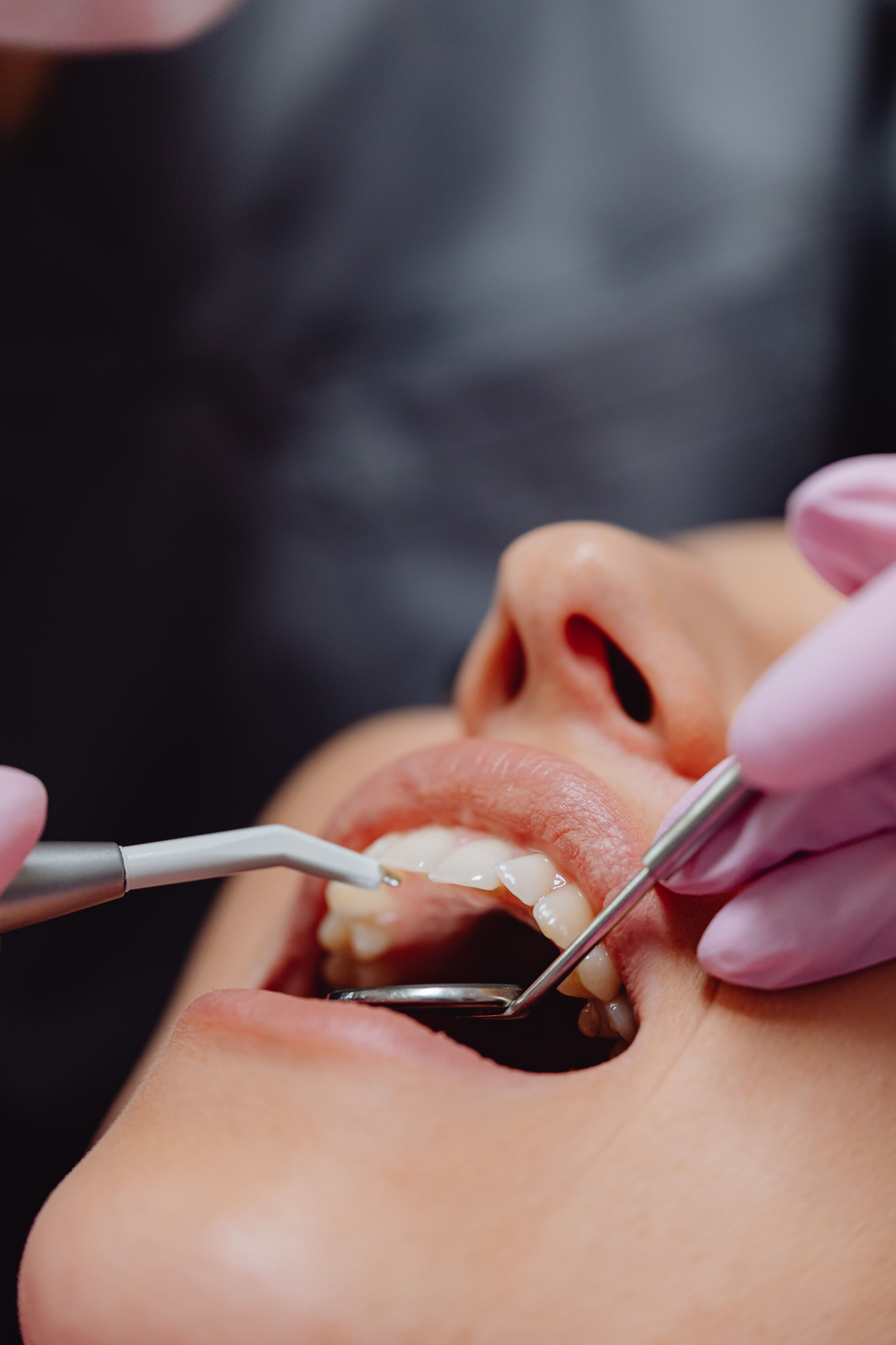 Surgical tooth extraction treatment at Hafeez Dental Care