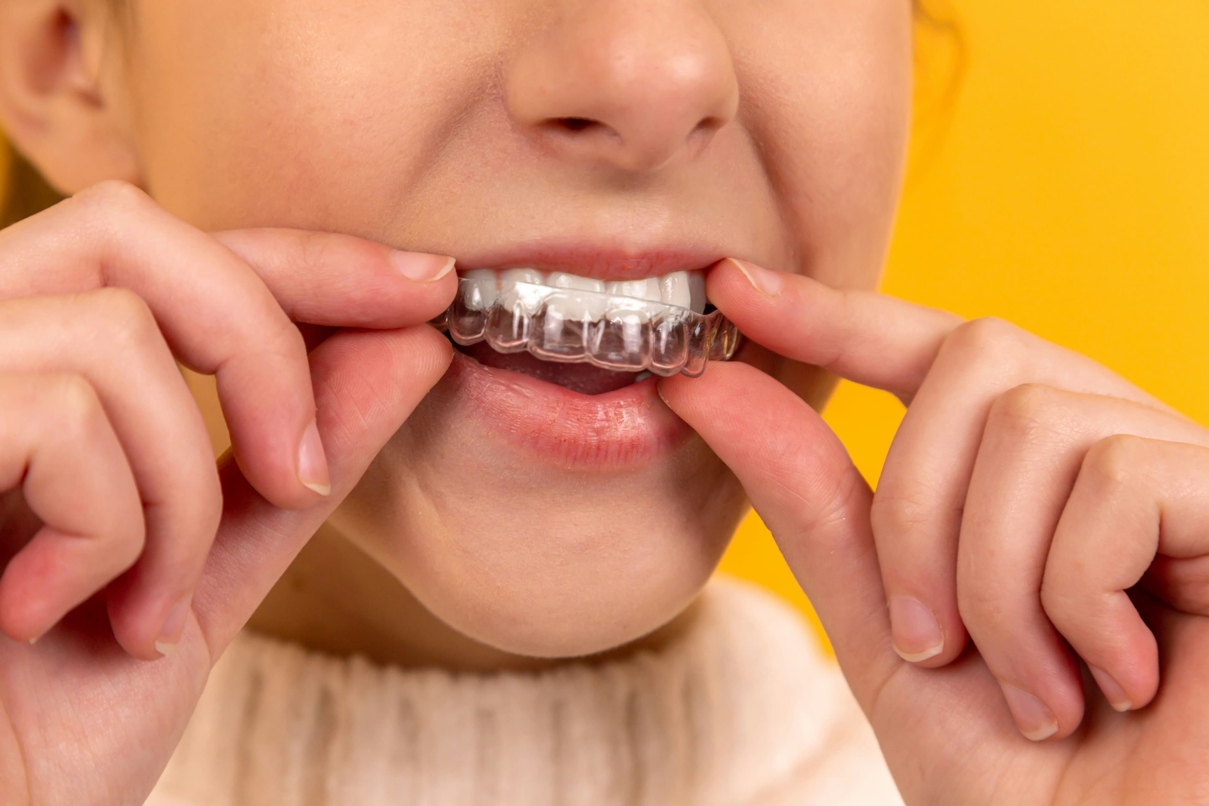 Professional teeth whitening treatment
