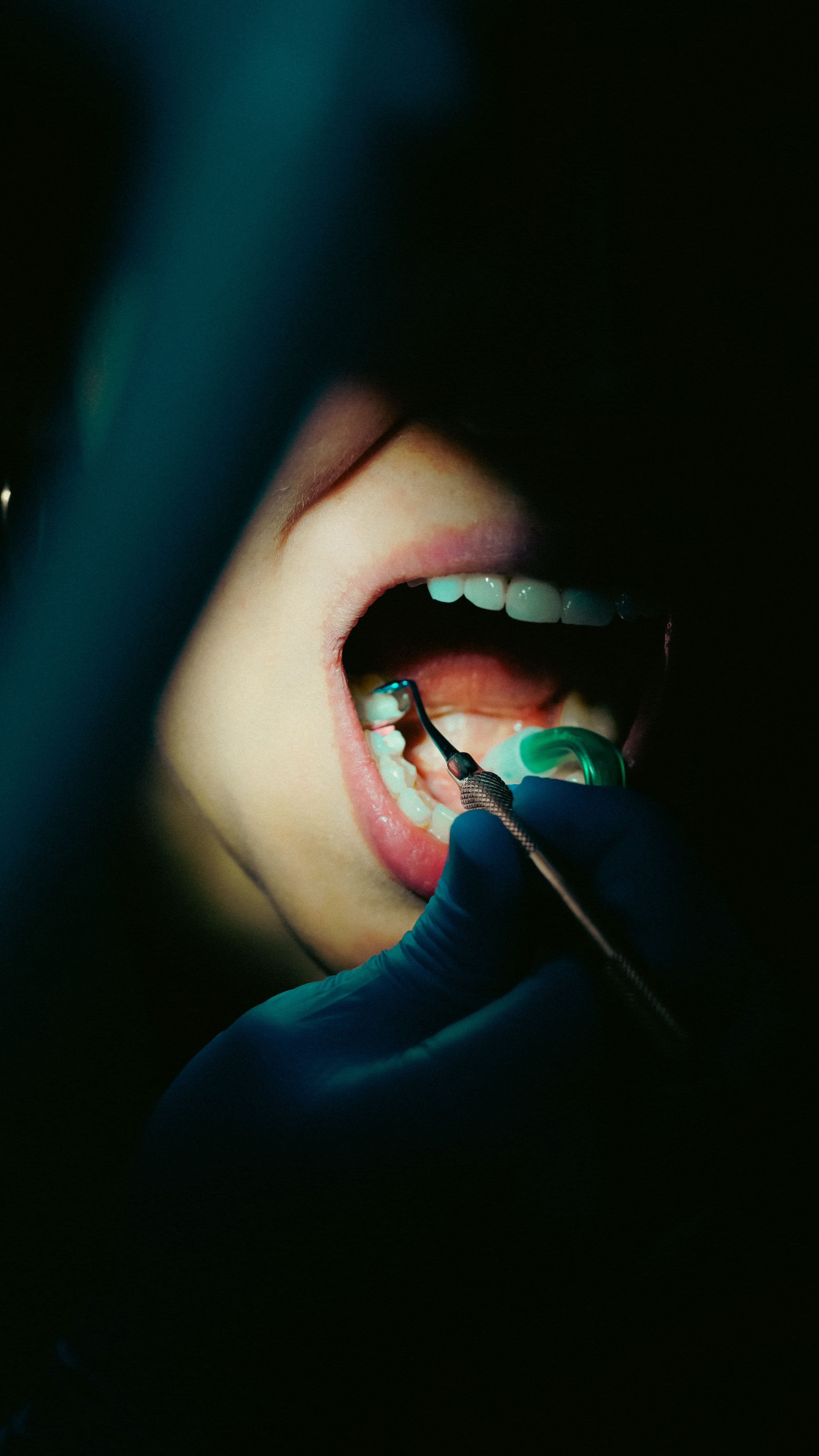 Dental filling treatment at Hafeez Dental Care